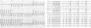 Electrocardiograms of two patients showing sustained monomorphic ventricular tachycardia (left image) and repetitive non-sustained monomorphic ventricular tachycardia (right image). Note the electrocardiographic morphology of left bundle branch block and inferior axis (left panel) and the rapid transition of QRS morphology from V1 to V2 (right panel).