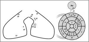 Schematic representation of the location of multifocal premature ventricular contractions for every patient included. Each number represents a PVC of a patient included (from 1 to 21). The left panel represents the right ventricle (lateral and septal walls on the left and middle panels, respectively) H: His bundle; Ao: aorta.