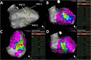 Pace-mapping map generated in patient 11. A total of 135 pacing points were acquired (A). The correlation percentage and a color-coded map were automatically generated for each premature ventricular contraction (PVC): (B) 94.4% (mid anteroseptal LV), (C) 97.3% (mid inferior LV) and (D) 96.1% (mid inferoseptal LV) for PVC1, PVC2 and PVC3, respectively. No local activation time points could be obtained in this patient due to the paucity of PVCs during the procedure.