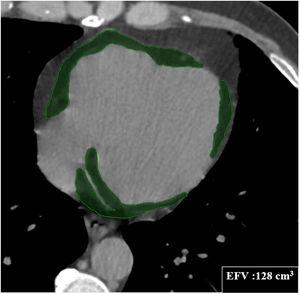 Computed tomography volumetric measurement of epicardial fat volume (EFV) in transaxial view.