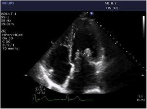 Parasternal long-axis view (1) and apical 4-chamber view (2) on transthoracic echocardiography showing multiple, mobile, echogenic masses in the left atrium invading the left ventricle and mitral and aortic valves.