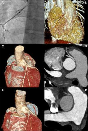 Coronary imaging, including preoperative invasive coronary angiography of the right coronary artery (A); computed tomography coronary angiography volume rendering (B and C) and multiplanar reformatting (D) and postoperative computed tomography coronary angiography volume rendering (E) and multiplanar reformatting (F). Coronary imaging revealed an anomalous origin of the non-dominant right coronary artery from the left sinus of Valsalva, with a slit-like orifice, acute takeoff and an interarterial and intramural course. Postoperative imaging confirmed corrected origin of the right coronary artery without residual stenosis.