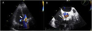 (A) Color Doppler in apical 5-chamber view showing aorto-RV fistula (white arrow); (B) short-axis view of aorta confirming a shunt between aorta and right ventricle, immediately above the insertion of the tricuspid annulus (white arrow).