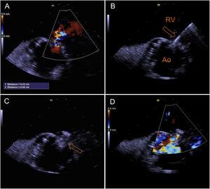 Two-dimensional intracardiac echocardiography of aorto-RV fistula closure. (A) Identification of aorto-RV fistula by color Doppler; (B) MP1 catheter crossing the defect; (C) 6 mm Amplatzer Vascular Plug II positioned; (D) no residual shunt was observed after device deployment.