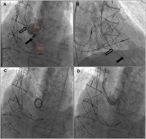 Fluoroscopic guidance of aorto-RV fistula closure. (A) Identification of aorto-RV fistula by aortography using a 5F pigtail catheter; (B) 6F MP1 catheter passing across the defect and an 0.035” Amplatzer guidewire positioned in the right ventricle; (C) 6 mm Amplatzer Vascular Plug II positioned; (D) after device deployment, no residual shunt was observed on angiography. Ao: aorta; RV: right ventricle.