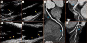 Panel A - baseline focal intimal hyperplasia (1 mm - arrowhead) of the right carotid bulb (long axis view); Panel B - baseline focal intimal hyperplasia (1.1 mm - arrowheads) of the left carotid bulb (long axis view); Panel C - 2 years’ follow-up of focal intimal hyperplasia (1 mm - arrowhead) of the right carotid bulb (long axis view); Panel D - 2 years follow-up with hyper-echogenicity and dimensional reduction (0.8 mm - arrowheads) at left carotid bulb (long axis view). We recorded a significant reduction in Doppler-derived coronary flow reserve (from 2.57 to 1.90). Panel E - right coronary artery at CT coronary angiography with focal, eccentric calcified plaques (arrowheads); Panel F - calcified eccentric plaque of the common trunk of the left coronary artery (arrowhead); Panel G - calcified eccentric plaque of the diagonal branch of the left coronary artery (arrowheads). Agatson score 93. LCCA: left common carotid artery; LECA: left external carotid artery; LICA: left internal carotid artery; RICA: right internal carotid artery.