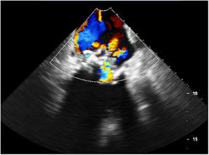 Doppler transesophageal echocardiogram showing mild to moderate eccentric mitral regurgitation.