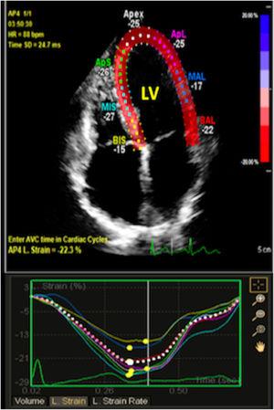 Representative speckle-tracking echocardiography apical four chamber view showing left ventricular global longitudinal strain.