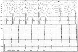 After programmed ventricular pacing, the extra-stimulus maintained eccentric and non-decremental ventriculoatrial conduction up to 220 ms, and it was at this time, when the atrioventricular node was outside the refractory period and available for anterograde conduction, that orthodromic atrioventricular reentrant tachycardia was induced (arrow).