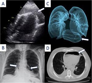 (A) Transthoracic echocardiogram showing air bubles swirling in the pericardial space (arrow). (B) Chest X ray demostrating air along the left and right borders of the heart (arrows). (C) Three-dimensional reconstruction of the airway and (D) chest tomography showing a big buble of air in the mediastinum (arrow).