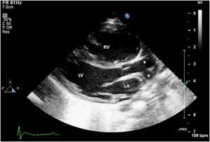 Transthoracic two-dimensional echocardiographic still, parasternal long-axis projection, showing the bifurcating great artery arising from the left ventricle (asterisks). LA: left atrium; LV: left ventricle; RV: right ventricle.