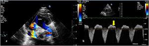 (a) Transthoracic color Doppler echocardiographic still, parasternal short-axis projection, showing the main pulmonary artery (MPA) continuing as left pulmonary artery (LPA) and (b) pulsed wave Doppler from the descending aorta showing pandiastolic flow reversal (yellow arrow). AO: aortic valve.