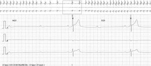 24-Hour Holter recording showing nocturnal complete atrioventricular block (ventricular pause of 6.6 s).