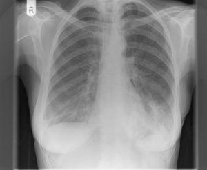Chest radiograph at presentation suggestive of consolidation at the both lung bases (predominantly on the left side).