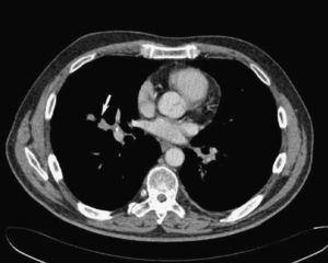 Pulmonar collision tumor: Metastatic adenoid cystic carcinoma and lung ...