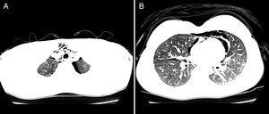 Lung scan revealed a pneumothorax in the left pleural cavity (A) and the pneumopericardium (B).