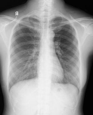 Follow-up chest radiograph showed complete resolution of subcutaneous emphysema and pneumothorax.