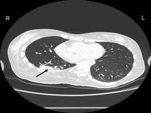 Successful treatment of atelectasis with Dornase alpha in a patient ...