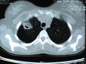 Surgical Treatment Of Aspergilloma Grafted In Hydatid Cyst Cavity ...