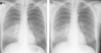 Exogenous lipoid pneumonia caused by chronic improper use of baby body ...