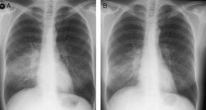 Chest X-rays at diagnosis (A) and six months after diagnosis (B). Extensive and intense infiltration with maximum intensity on the right side, in the area of segment S6 at diagnosis, and partial regression of pulmonary infiltration six months later.