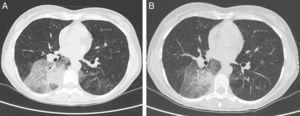 Chest high-resolution computed tomography (HRCT) at diagnosis (A) and two years after diagnosis (B). Bilateral lung infiltration in the lower lobes, particularly on the right side in the area of segment S6, with the following dimensions: 85mmÿ38mmÿ70mm. The surrounding tissue shows ground-glass opacities, thickened interlobular septa, and a craving paving picture with air bronchogram (A). Partial regression of pulmonary infiltration after discontinuation of ⿿baby body oil therapy⿿ (B).