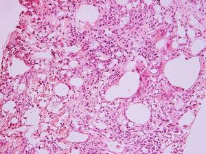 Hematoxylin- and eosin-stained slide (ÿ200) of patient's lung tissue. Instead of normal alveoli in the lung, there are empty spaces of different sizes, lined with partially flattened multinucleated giant cells. Between those empty places, there is fibrous connective tissue, sometimes with infiltration of lymphocytes. In the connective tissue, there are also foreign body granulomas with large multinucleated cells that have vacuoles in the cytoplasm. The lesions do not have a distinct margin from the normal lung.