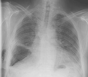 Radiografia del torace il 12 ° giorno dopo la lobectomia midle destra e 24h dopo la rimozione del tubo toracico.