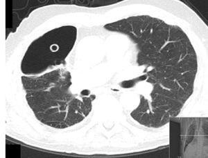 Thoracic CT-skanning som viser pleurhulen med brystrør inne og pleural fortykkelse.