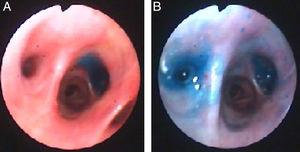 Bleu de méthylène sur les segments B7 (Panneau A) et B6 (panneau B) du lobe inférieur droit après instillation à travers le tube thoracique.