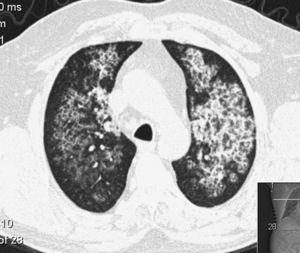 Bilateral whole lung lavage in pulmonary alveolar proteinosis – A ...