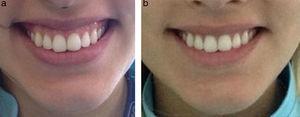 Foto extra oral del caso. a) Sonrisa inicial mostrando una exposición considerable de tejido gingival. b) Sonrisa en la evaluación postoperatoria de 2 semanas posterior a la aplicación de TBX-A.