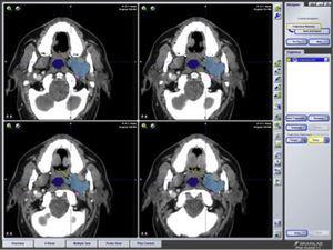 Diseño de trayectorias para acceso a un tumor del espacio pterigomaxilar.