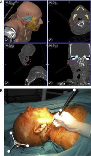 A y B. Carcinoma epidermoide recidivante de piel. Navegación de los márgenes de resección.