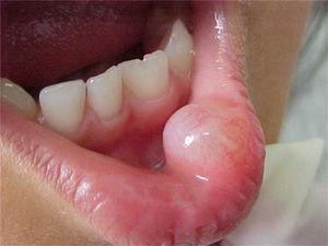 Clinical apperance of an intraoral labial enlargement resembling a mucocele.