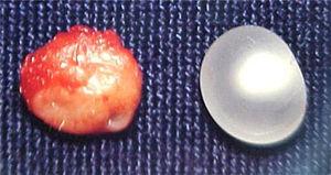 Macroscopic view of the lesion and the capsule and surrounding tissue.