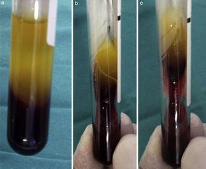 A. Tubo de recolección sanguínea tras la centrifugación. B y C. Separación del coágulo de fibrina del plasma acelular (parte superior) y de los eritrocitos (parte inferior).