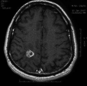 T1 weighted axial MRI showing a right parietal mass with gadolinium enhancement.