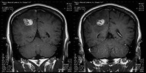 T1 coronal MRI demonstrating a parietal mass with heterogenous enhancement.