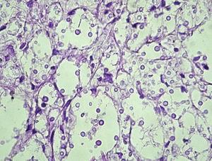 Meningeal space showing numerous Cryptococcus cells. H/E×100.