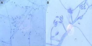 Morphology of conidiophores and conidia of Fusarium dimerum. Microscopic observation of a microculture on Sabouraud dextrose agar. Lactophenol blue stain (A: 200×; B: 1000×).
