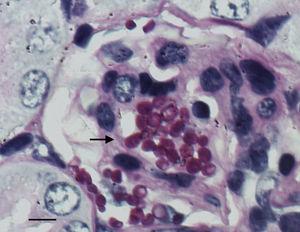 aanwezigheid van schimmelinfiltratie (zwarte pijl) in het niergedeelte van een controlemuis geïnfecteerd met C. guilliermondii, 8 dagen na infectie (periodieke zure Schiff kleuring, vergroting 1000×). Bar = 10µm.