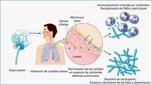 Ciclo de vida infeccioso del género Aspergillus en su interacción con los principales tipos de pacientes inmunodeprimidos (neutropénicos y trasplantados en terapia con corticoides u otros inmunosupresores). PMN: leucocitos polimorfonucleares. Figura adaptada de Dagenais y Keller16.