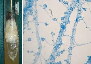 Positive culture of Sporothrix schenckii on Sabouraud agar (left). Photomicrograph of the fungus stained with lactophenol cotton blue under light microscopy (400×). Its mycelial form is seen with typical conidiophores bearing conidia as a bouquet at the tip (right).