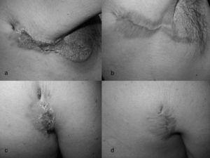 (a) Verrucous plaque (initieel); (b) na behandeling; (c) Fistulae en ulceratieve laesie (initieel); (d) na behandeling.