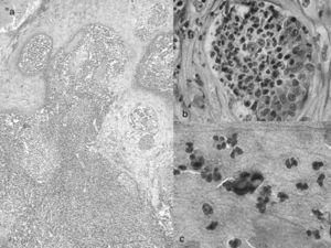 (a) Hisztopatológia, tuberkuloid granuloma (HE, ×10). (b) Mikroabszcesszus blastoconidiumokkal (HE, ×100). (c) Blastokonídiumok vastag bázissal (Giemsa, ×100).