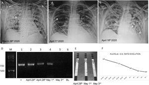 (A–C) Chest X rays showing the evolution of the patient. (D) Gel electrophoresis of nested PCRs: lane M, molecular weight (1kb ladder); lane 1, positive control using human serum spiked with 10ng of Aspergillus fumigatus LMDM-31 DNA as sample; lanes 2–4, nested PCR results using DNA obtained from the 3 first samples submitted (743pb band); lane 5, negative nested PCR result using DNA extracted from the 4th sample (May 3rd); lane 6, nested PCR blank. (E) Results obtained with SŌNA™ Aspergillus GM-LFA (Immy) showing positive bands in the samples of the days April 28th and May 1st (coinciding with the results obtained with the nested PCR). (F) OD ratio evolution using Platelia™ Aspergillus EIA (BioRad).