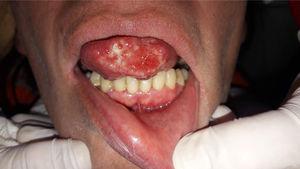 Granulomatous lesion on the tip of the tongue.