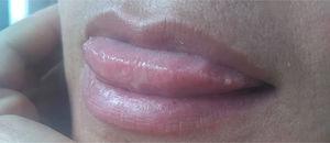Tongue appearance after treatment.