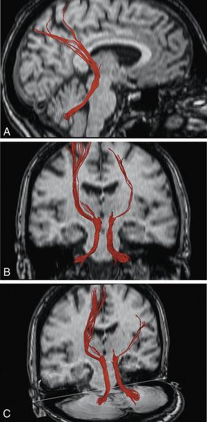 Demostración de los pedúnculos cerebelosos superiores y sus proyecciones talamocorticales mediante imágenes de DTT en distintos planos de RM cerebral.